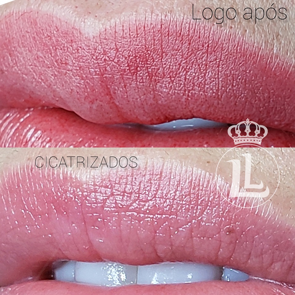 Micropigmenta&ccedil;&atilde;o labial
