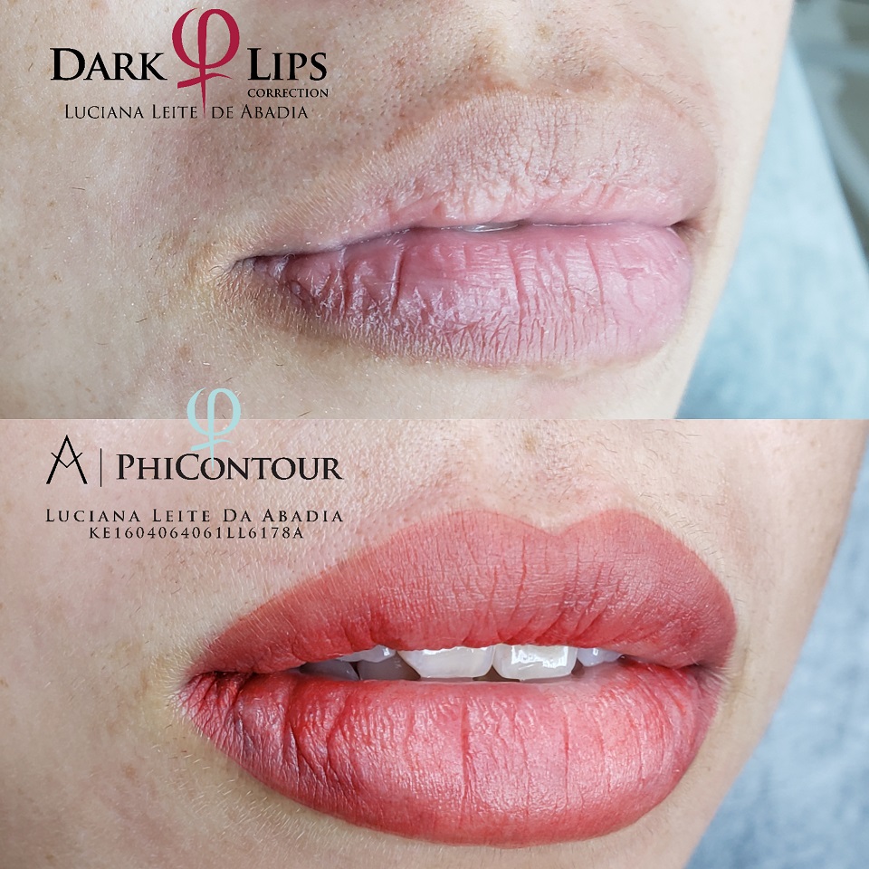 Procedimento de Neutraliza&ccedil;&atilde;o Labial