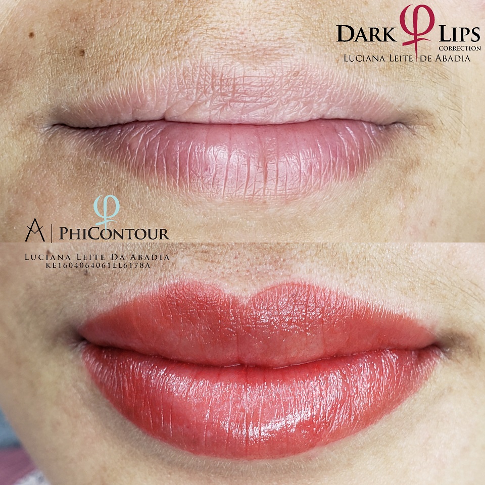 Procedimento de Neutraliza&ccedil;&atilde;o Labial