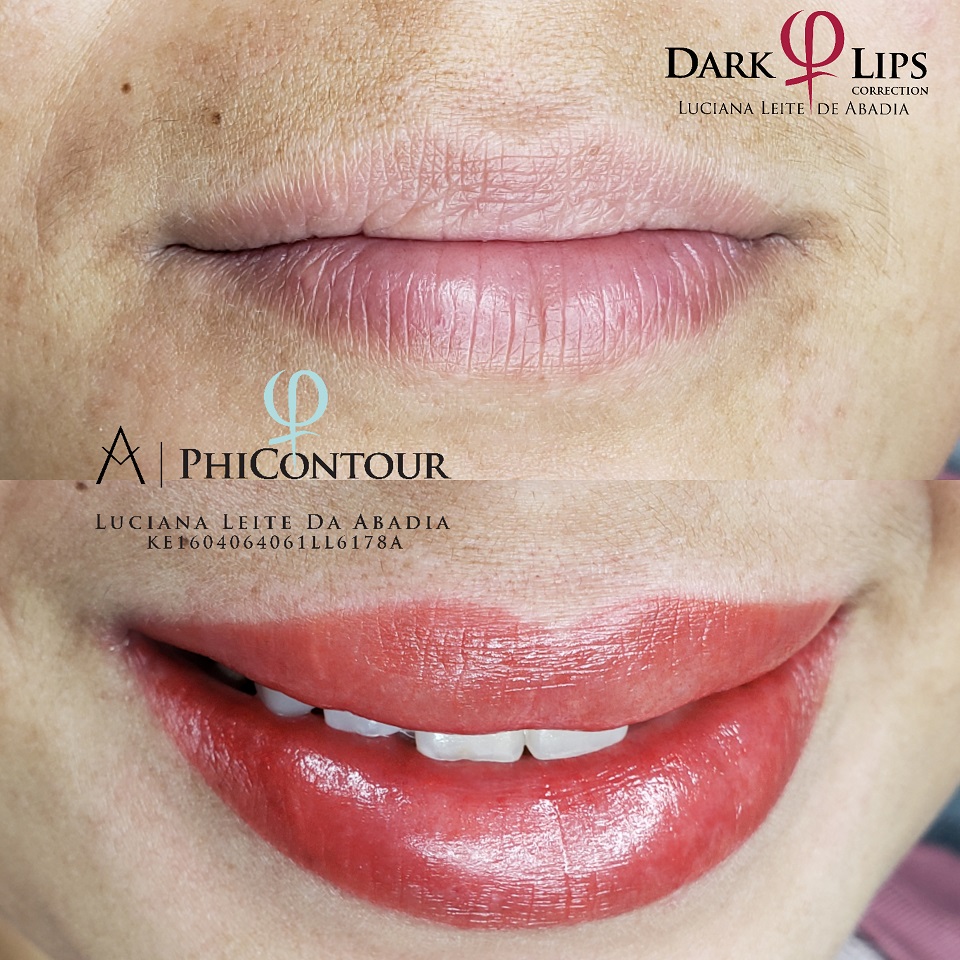 Procedimento de Neutraliza&ccedil;&atilde;o Labial