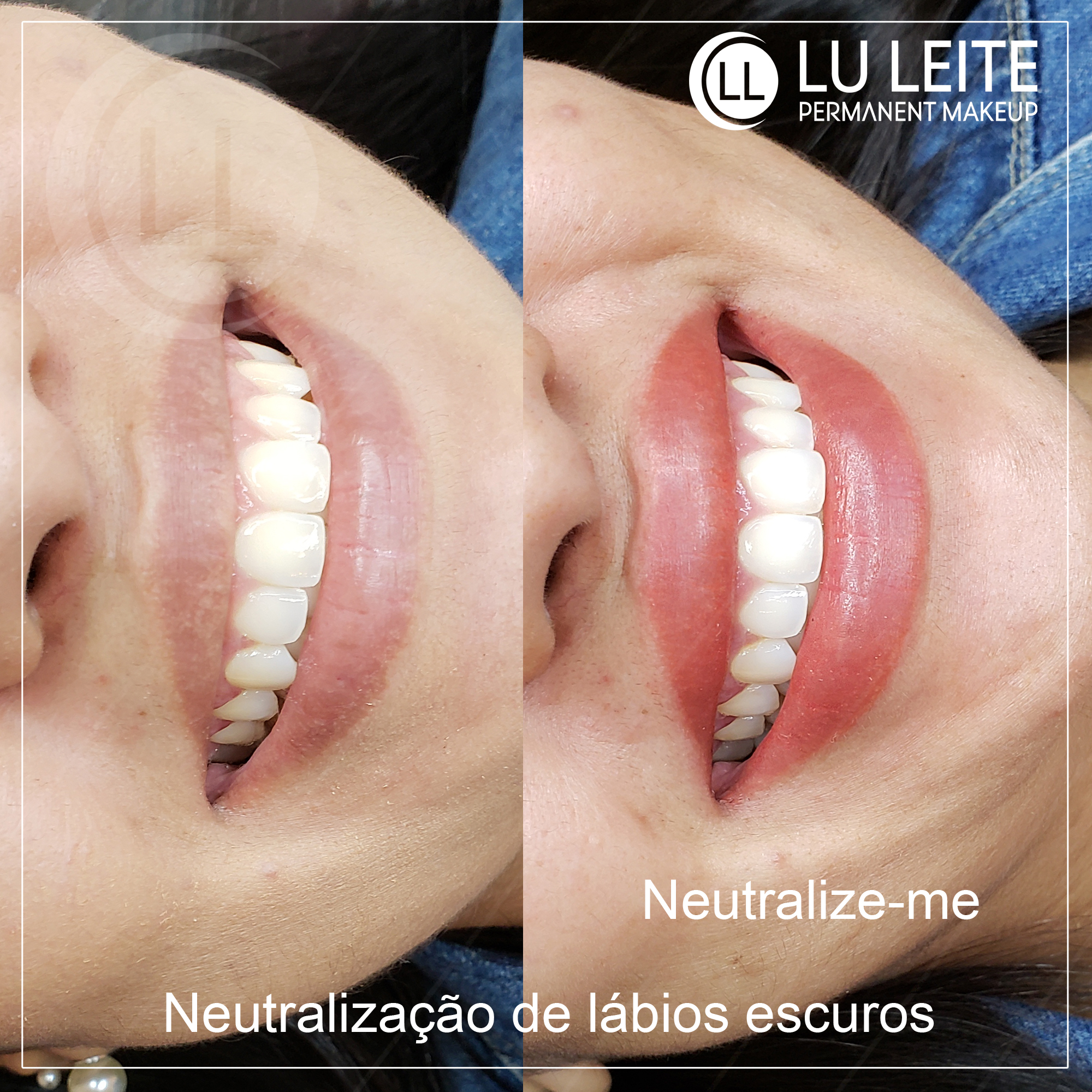 Neutraliza&ccedil;&atilde;o labial