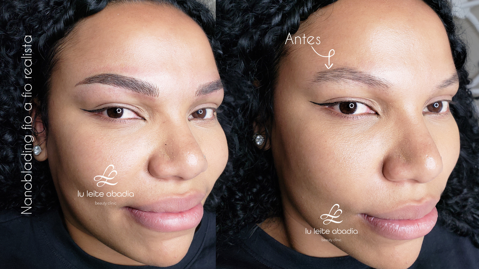 Antes e depois de procedimento de fio a fio realista